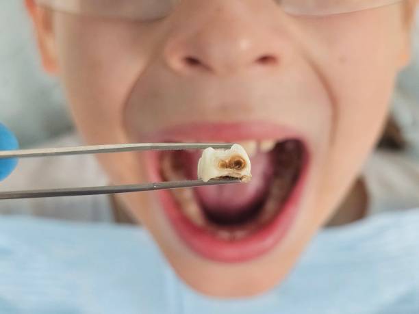 Best Emergency Broken Tooth Repair in Hazel Green, AL